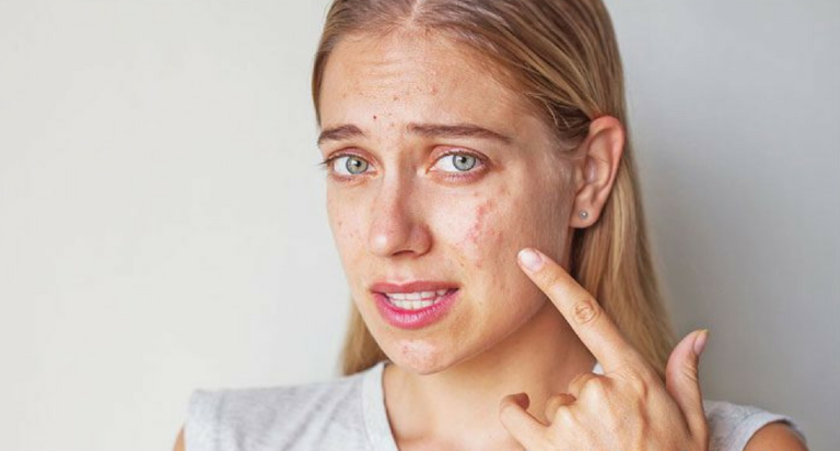 adult acne
